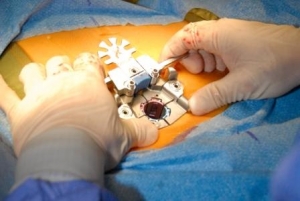 جراحی باز؛ درمان دیسک کمر