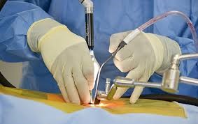 جراحی آندوسکوپی، شیوه جراحی درمان دیسک