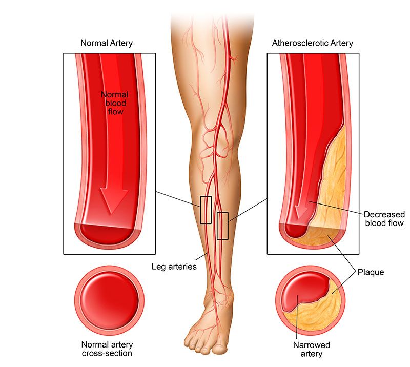 علت درد پای چپ از زانو به پایین
