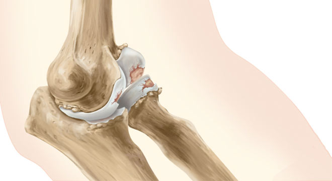 عکس خشکی مفصل آرنج 