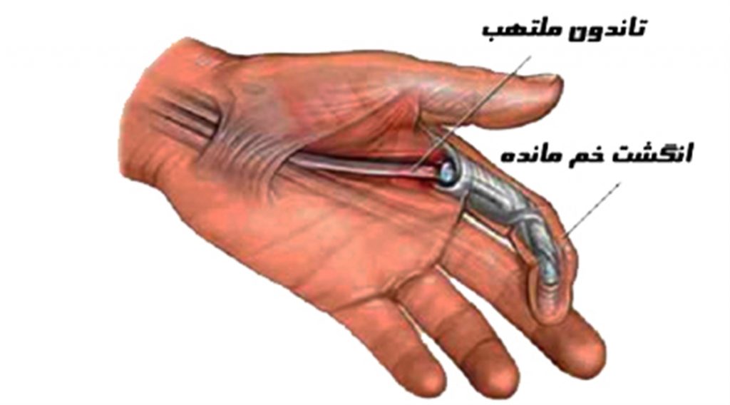 علائم کشیدگی تاندون دست راست