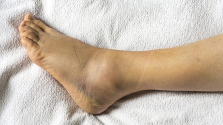 علت درد قوزک پا هنگام راه رفتن