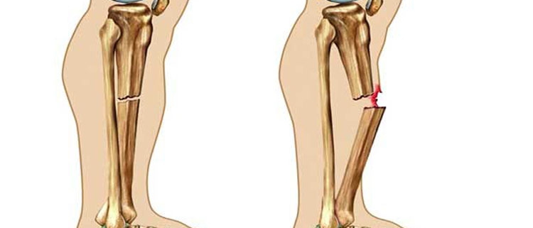 درمان شکستگی ساق پا