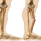 درمان شکستگی ساق پا