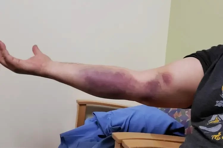 عکس علائم پارگی تاندون دوسر بازو