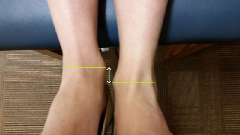 درمان اختلاف طول پا