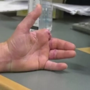 پیوند انگشت قطع شده